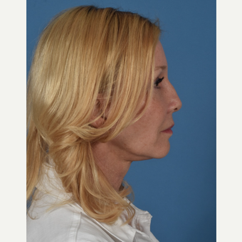 55-64 year old woman treated with Facelift after 3437575