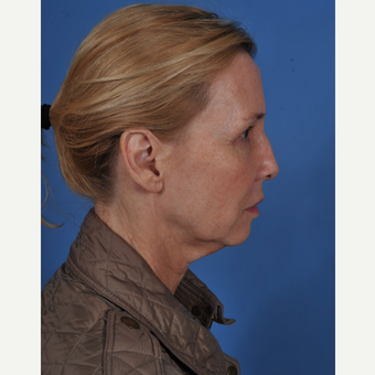 55-64 year old woman treated with Facelift before 3437575