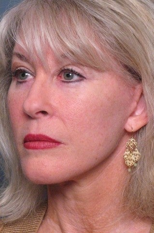 Facelift, Brow Lift, Upper & Lower Eyelid Surgery after 337345