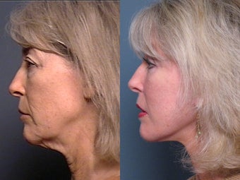 Facelift, Brow Lift, Upper & Lower Eyelid Surgery 337345