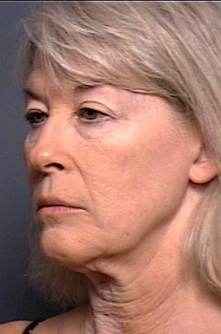 Facelift, Brow Lift, Upper & Lower Eyelid Surgery before 337345