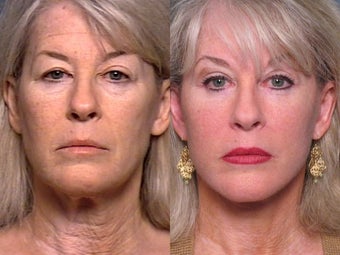 Facelift, Brow Lift, Upper & Lower Eyelid Surgery 337345