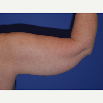 35-44 year old woman treated with Smart Lipo before 3649485