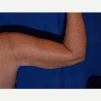 35-44 year old woman treated with Smart Lipo after 3649485