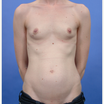 Breast Augmentation (435gm) before 3052381