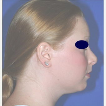 Rhinoplasty after 3324474