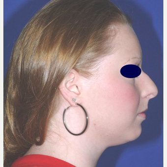 Rhinoplasty before 3324474