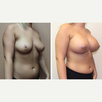 25-34 year old woman treated with Breast Augmentation after 3299872