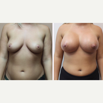25-34 year old woman treated with Breast Augmentation before 3299872