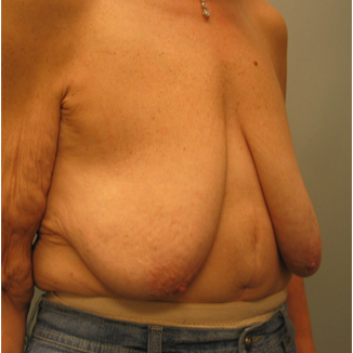 Body Lift before 3680271