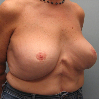 Body Lift after 3680271