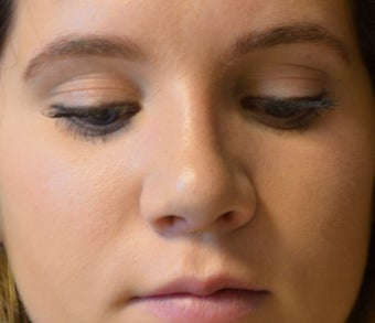 18-24 year old woman treated with Rhinoplasty 2765387