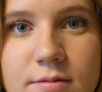 18-24 year old woman treated with Rhinoplasty 2765387