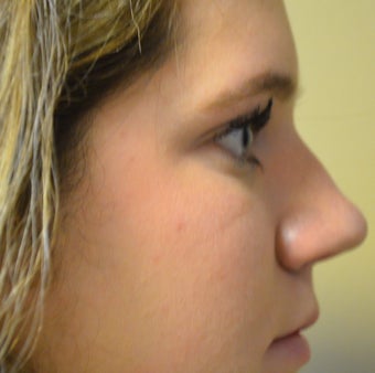 18-24 year old woman treated with Rhinoplasty before 2765387