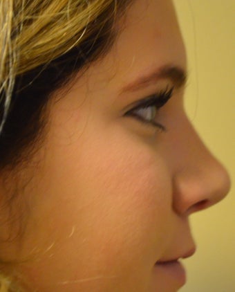 18-24 year old woman treated with Rhinoplasty after 2765387