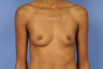 27 Year Old Woman Breast Augmentation Silicone Breast Implants A Cup to D Cup before 698355