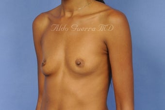 27 Year Old Woman Breast Augmentation Silicone Breast Implants A Cup to D Cup 698355