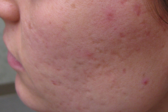 Acne scar revision treatment before 1307659