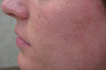 Acne scar revision treatment after 1307659
