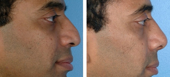 Revision Rhinoplasty before 1208291
