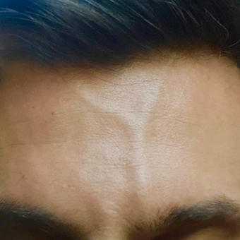 35-44 year old man treated for forehead veins with sclerotherapy and microphlebectomies. before 3087220