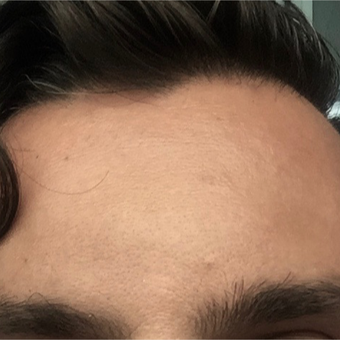35-44 year old man treated for forehead veins with sclerotherapy and microphlebectomies. after 3087220