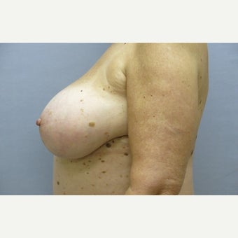 68 year old woman treated with Breast Implant Removal and mastopexy 1675017