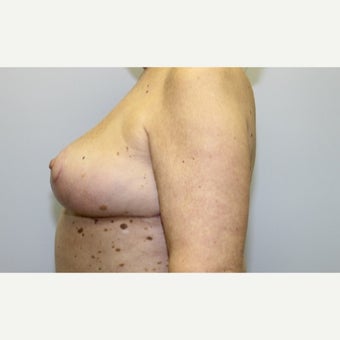 68 year old woman treated with Breast Implant Removal and mastopexy 1675017