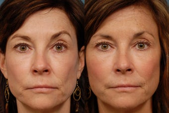 Sculptra before 407011