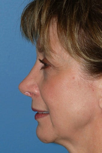 Revision Rhinoplasty after 68971