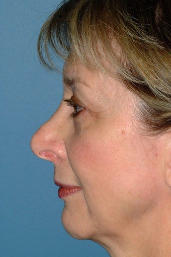 Revision Rhinoplasty before 68971