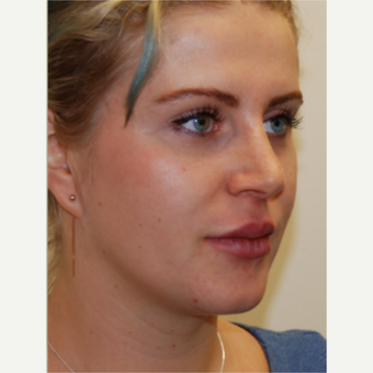 25-34 year old woman treated with Rhinoplasty and permanent Lip Augmentation. after 3742310