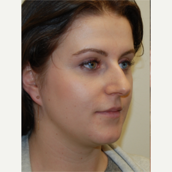 25-34 year old woman treated with Rhinoplasty and permanent Lip Augmentation. before 3742310