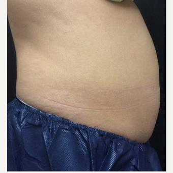 35-44 year old woman treated with CoolSculpting before 3382652