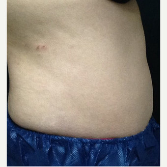 35-44 year old woman treated with CoolSculpting after 3382652
