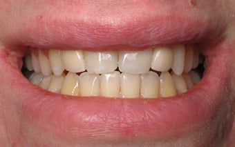 Dental Implants to Replace Missing Teeth after 264191