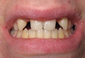 Dental Implants to Replace Missing Teeth before 264191