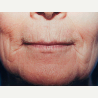 Dermabrasion before 3814108