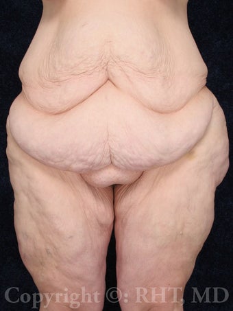38 year old woman after 170 lb. weight loss from gastric bypass underwent Lower Body Lift (circumferential beltlift) before 254674