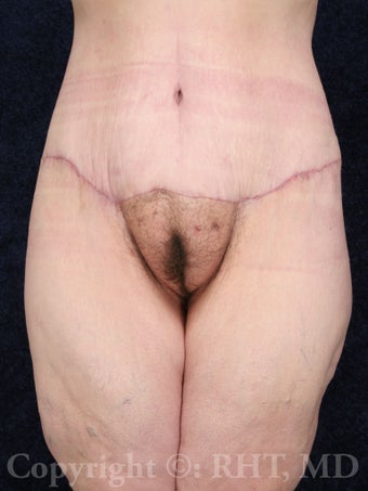 38 year old woman after 170 lb. weight loss from gastric bypass underwent Lower Body Lift (circumferential beltlift) after 254674