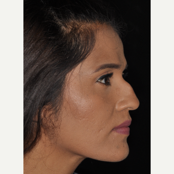 25-34 year old woman treated with Nose Surgery 10 days post-op before 3452321