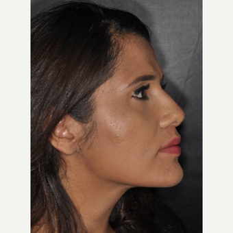 25-34 year old woman treated with Nose Surgery 10 days post-op after 3452321
