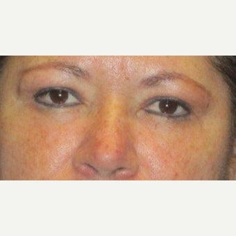 45-54 year old woman treated with Fat Transfer and lower eyelid laser with upper blepharoplasty after 1539453