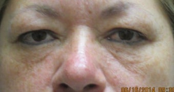 45-54 year old woman treated with Fat Transfer and lower eyelid laser with upper blepharoplasty before 1539453