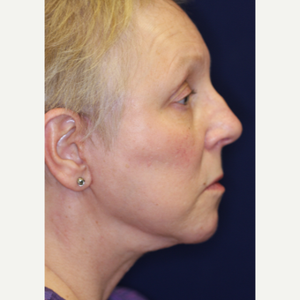 55-64 year old woman treated with Facelift after 3070846