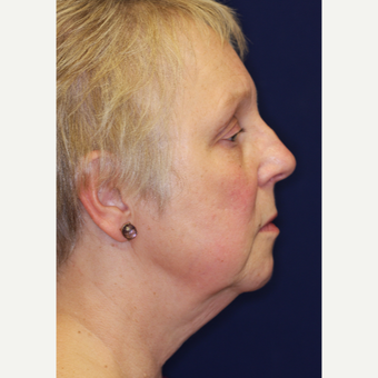 55-64 year old woman treated with Facelift before 3070846