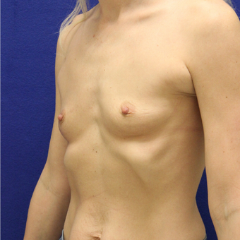 18-24 year old woman treated with Breast Augmentation before 3383391