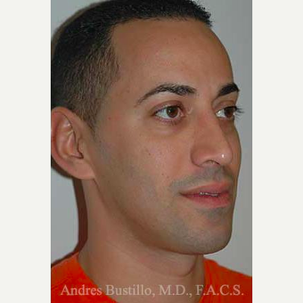 37 year old man treated with Rhinoplasty after 3462317