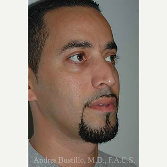 37 year old man treated with Rhinoplasty before 3462317