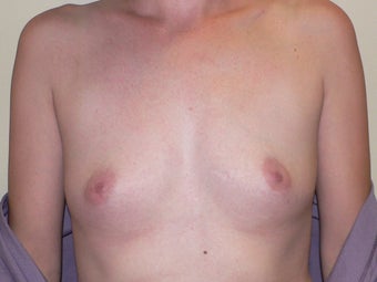 Breast Augmenation before 943769